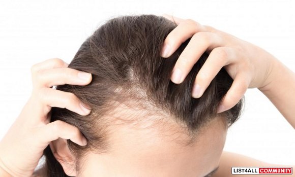 Treating Female Pattern Baldness With Natural Treatment