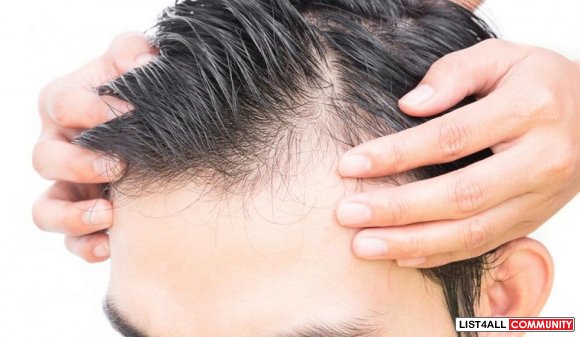 Effective Male Pattern Hair Loss Treatment and Products